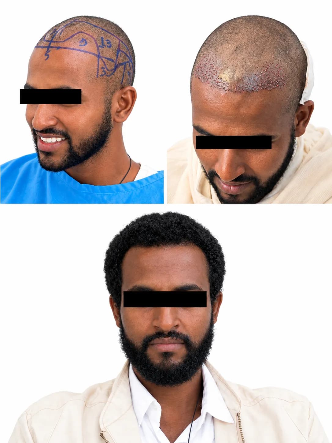 Goferie hair transplant recovery