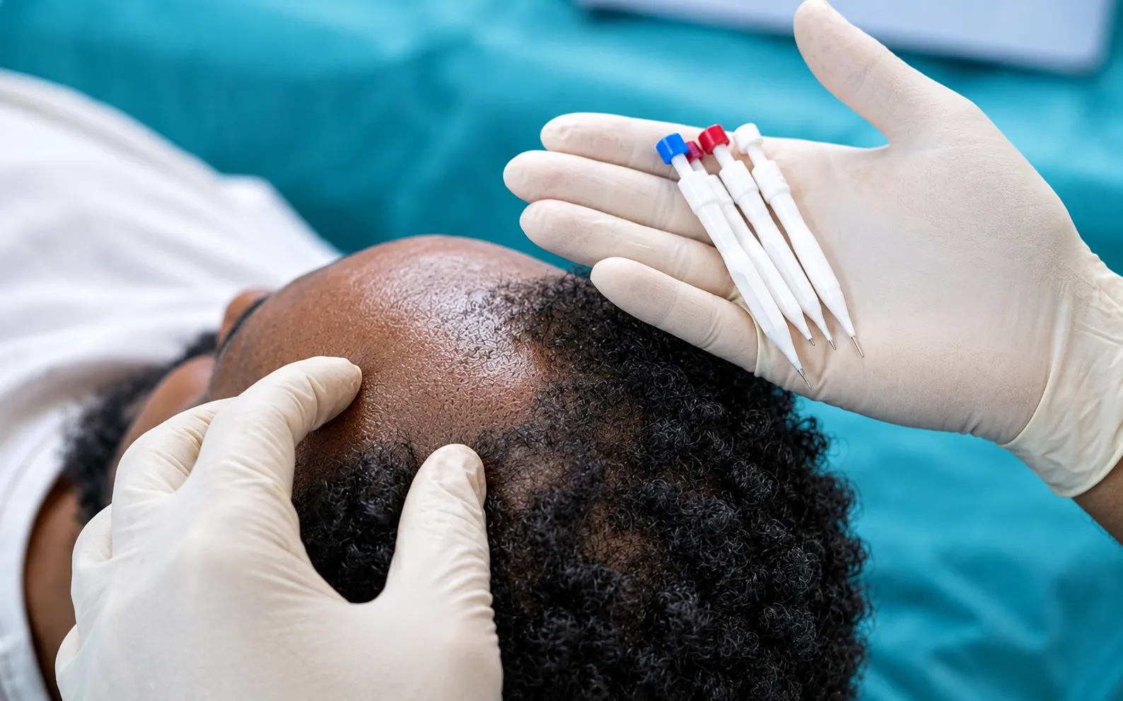 Hair transplant advanced technology