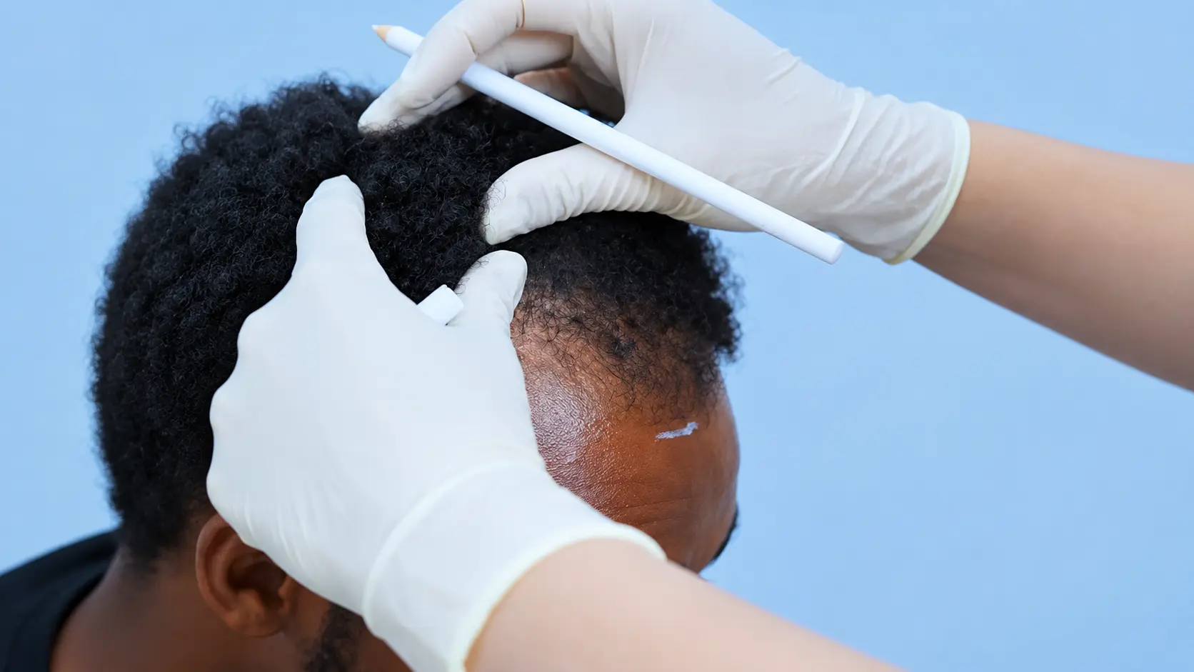 Natural-looking hairline design at Goferie Hair Transplant