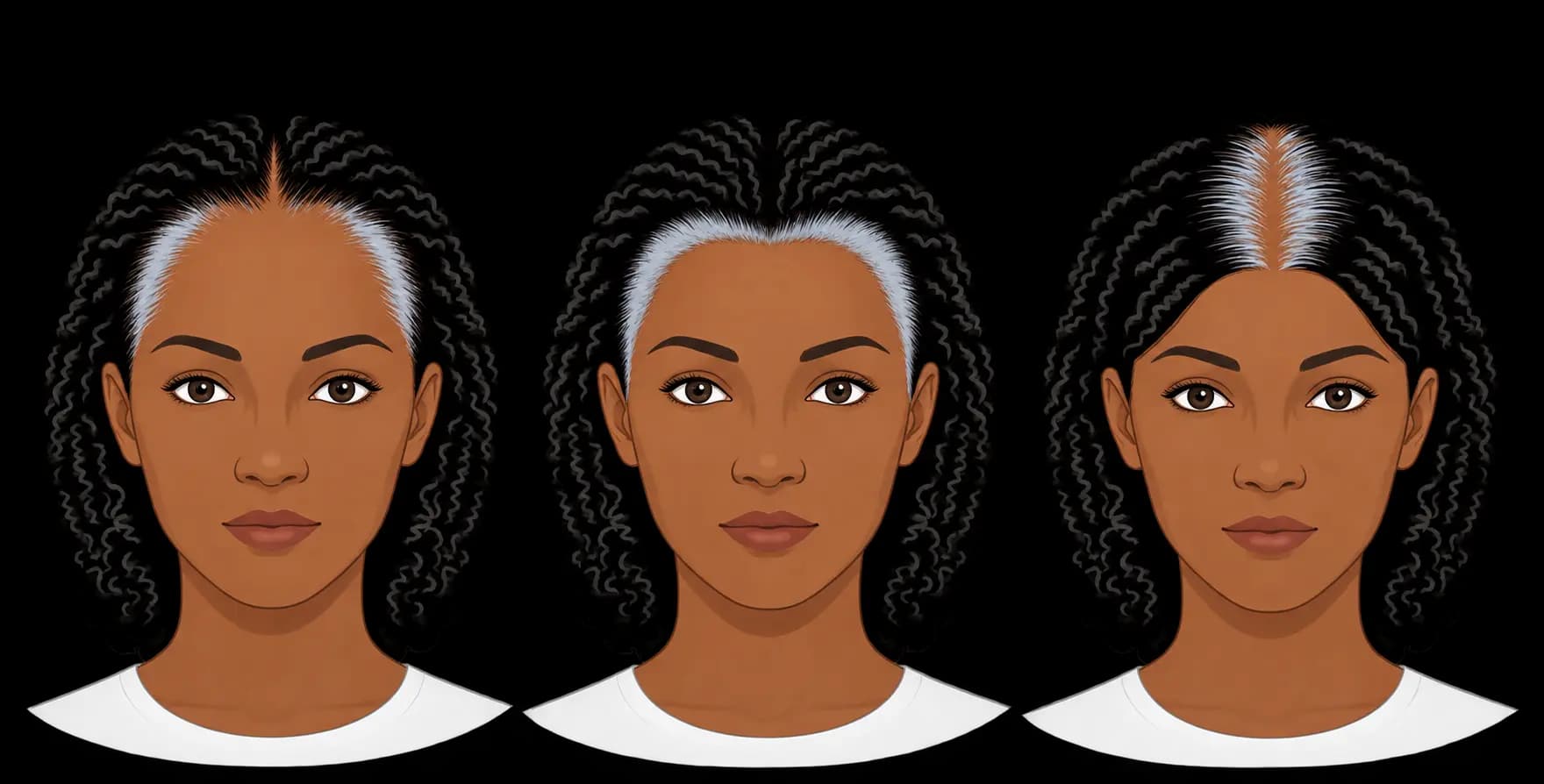 FUE hair transplant