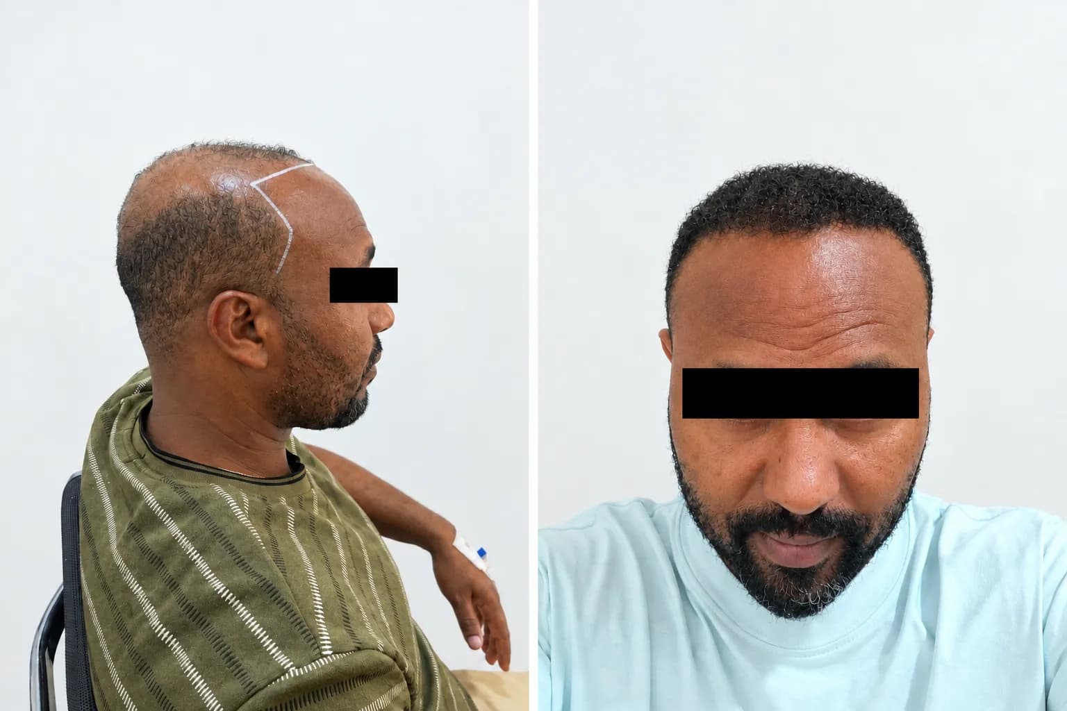 Yoni B. hair transplant before and after