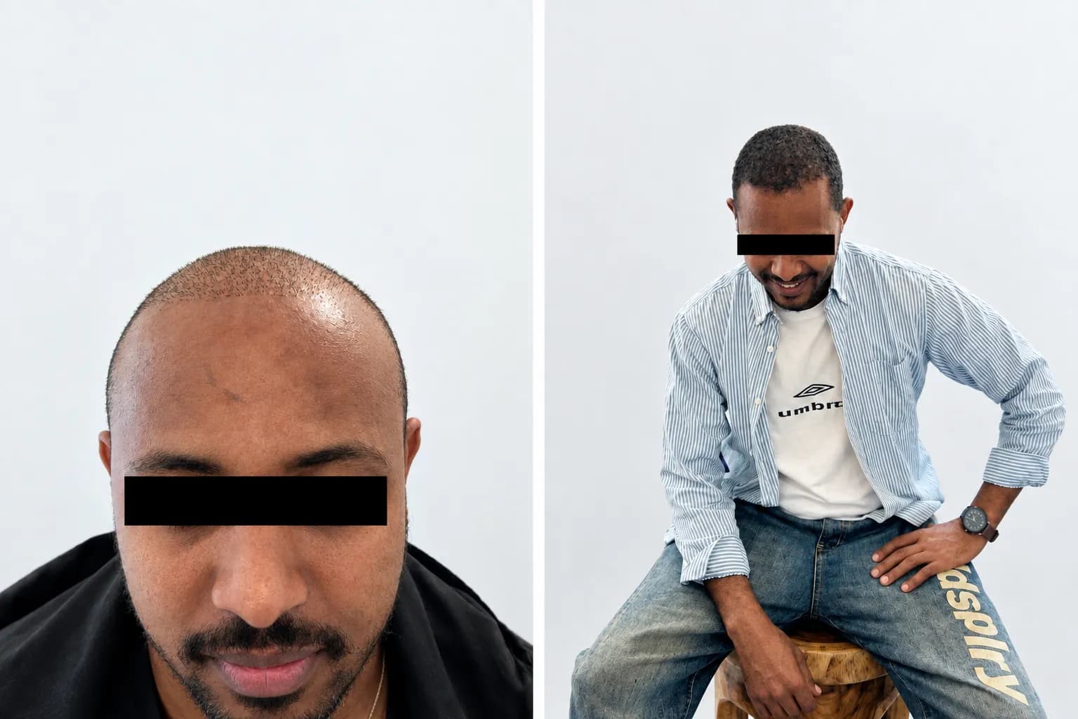 Abebe B. hair transplant before and after