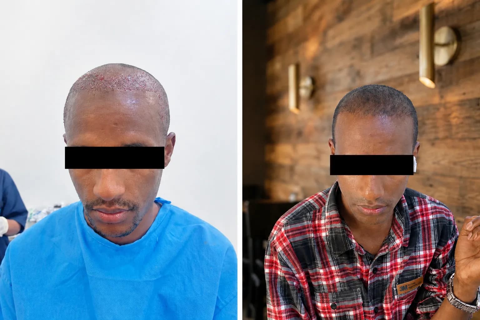 Abera A. hair transplant before and after