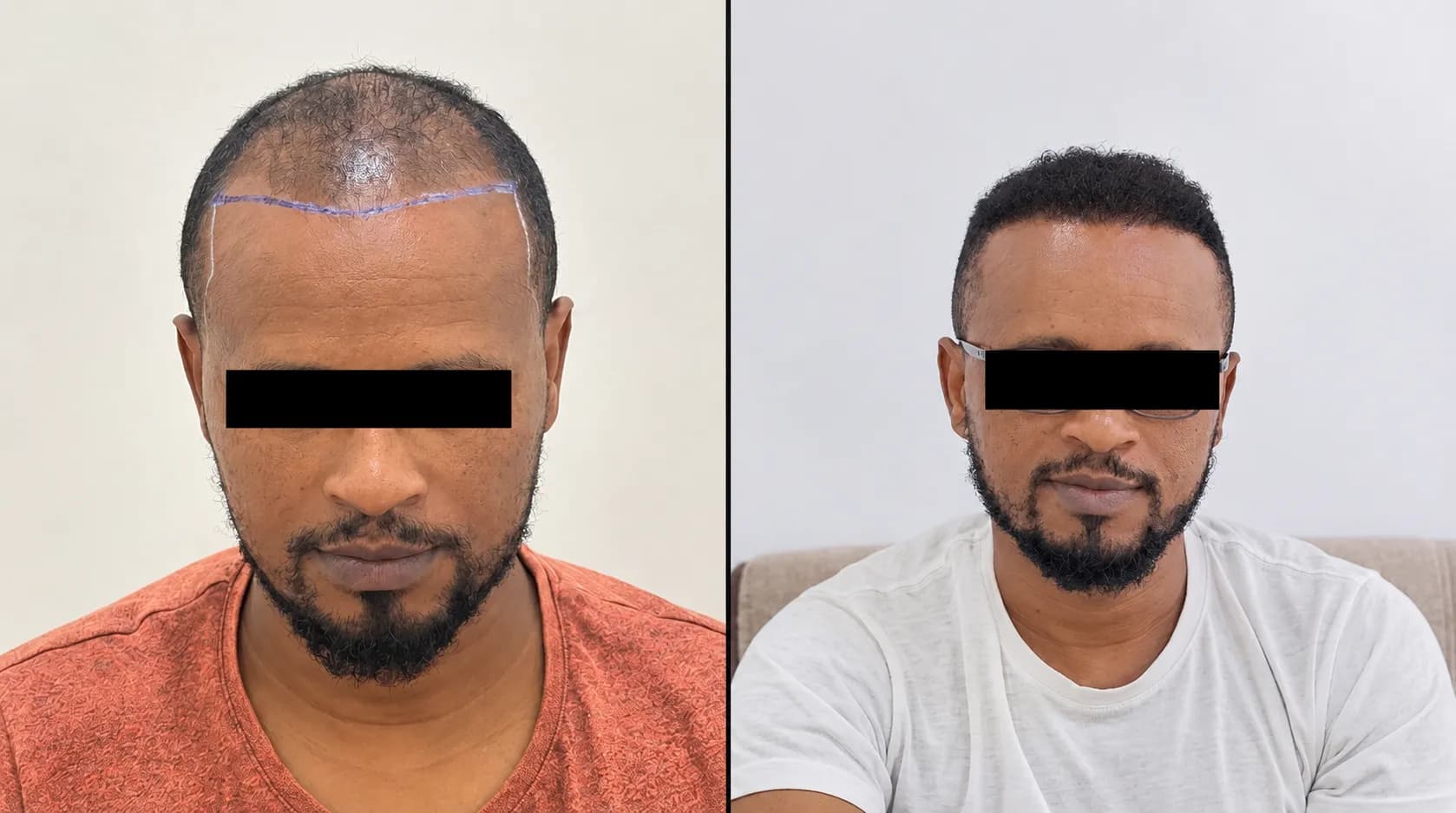 Biruk B. hair transplant before and after