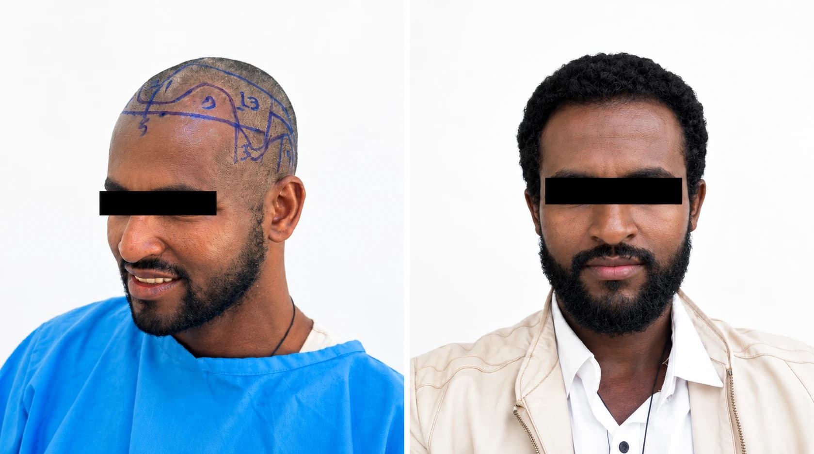 DHI hair transplant before and after