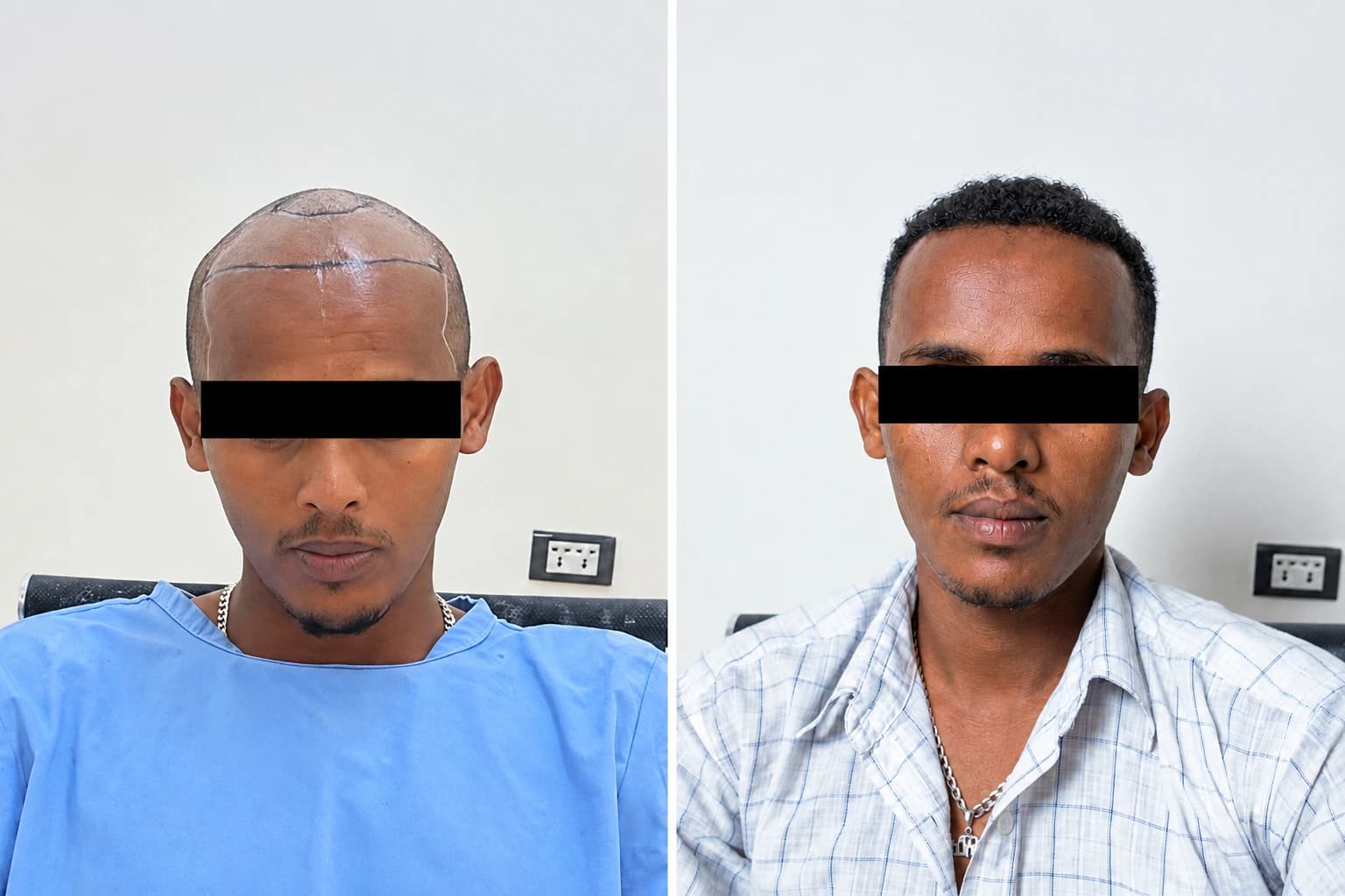DHI hair transplant before and after