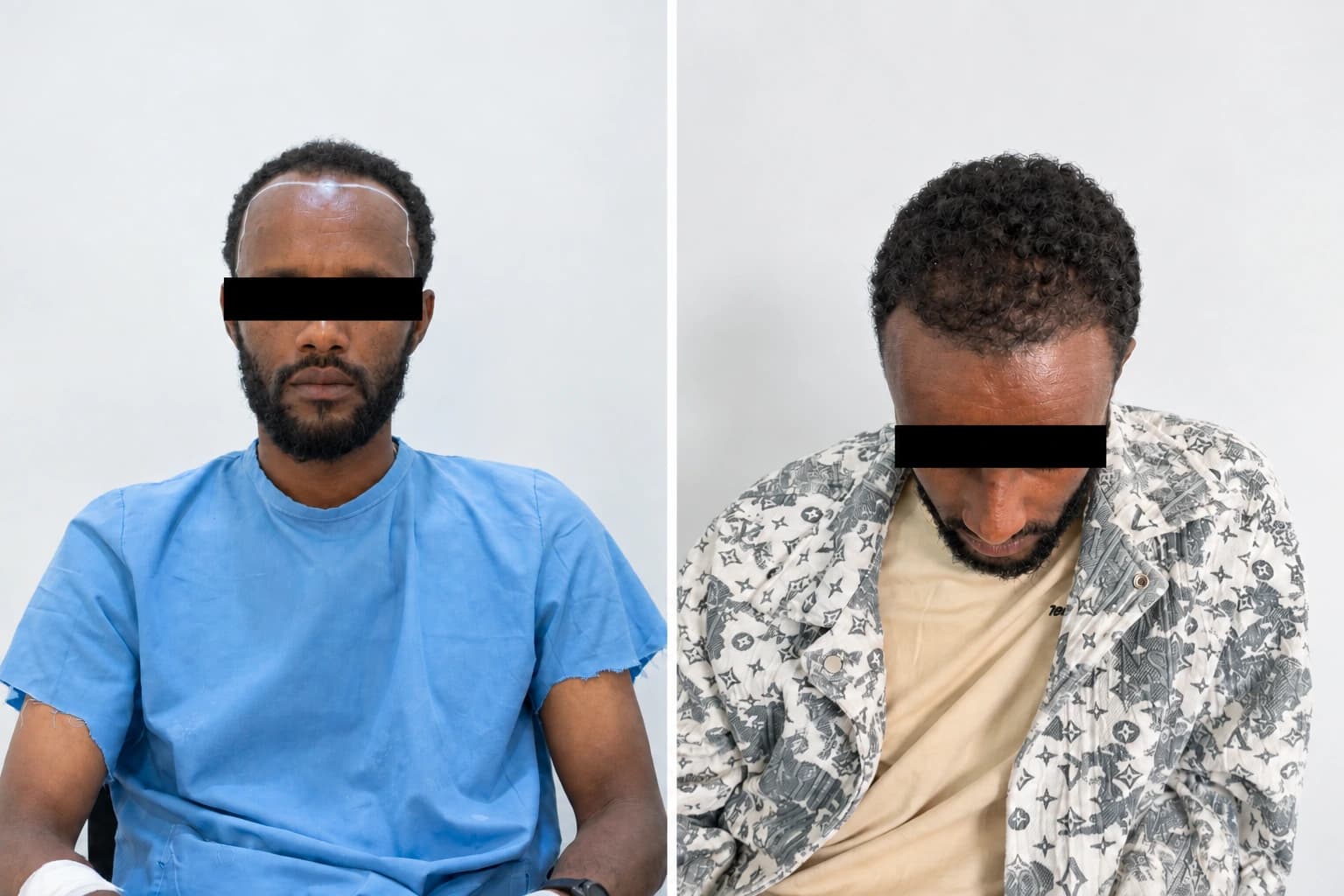 Abraham P. hair transplant before and after