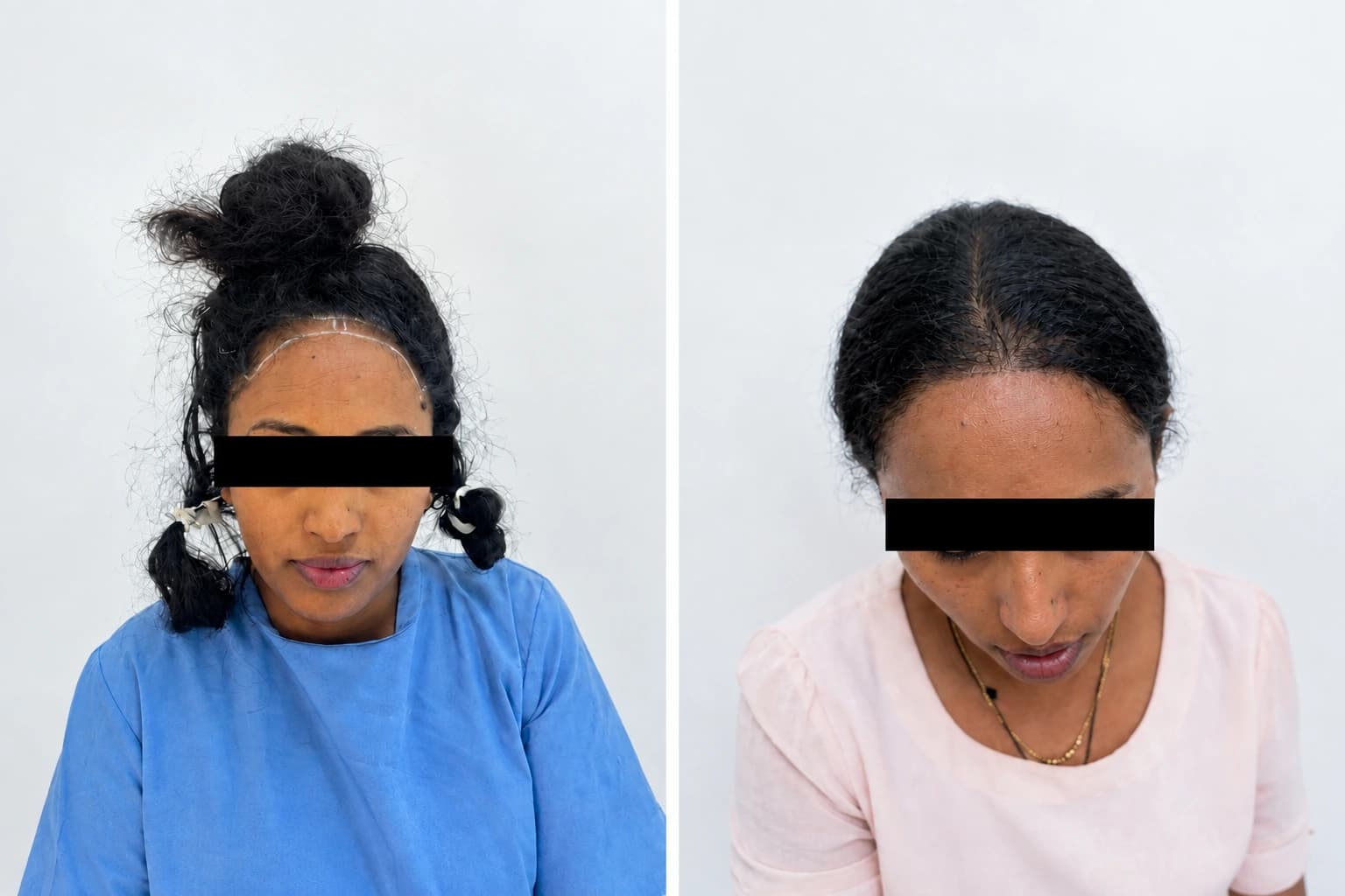 Hirut B. hair transplant before and after