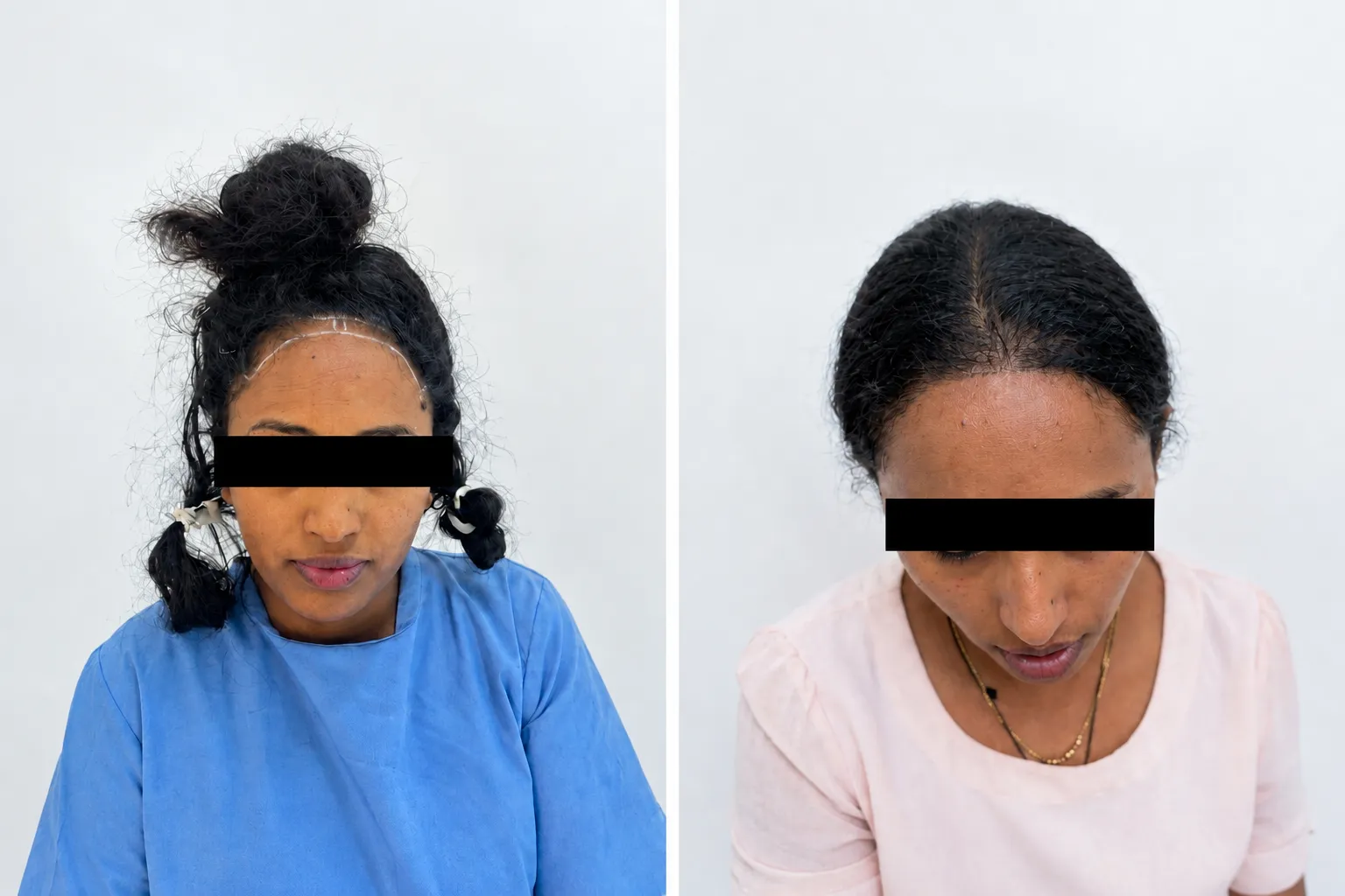Women before and after hair transplant