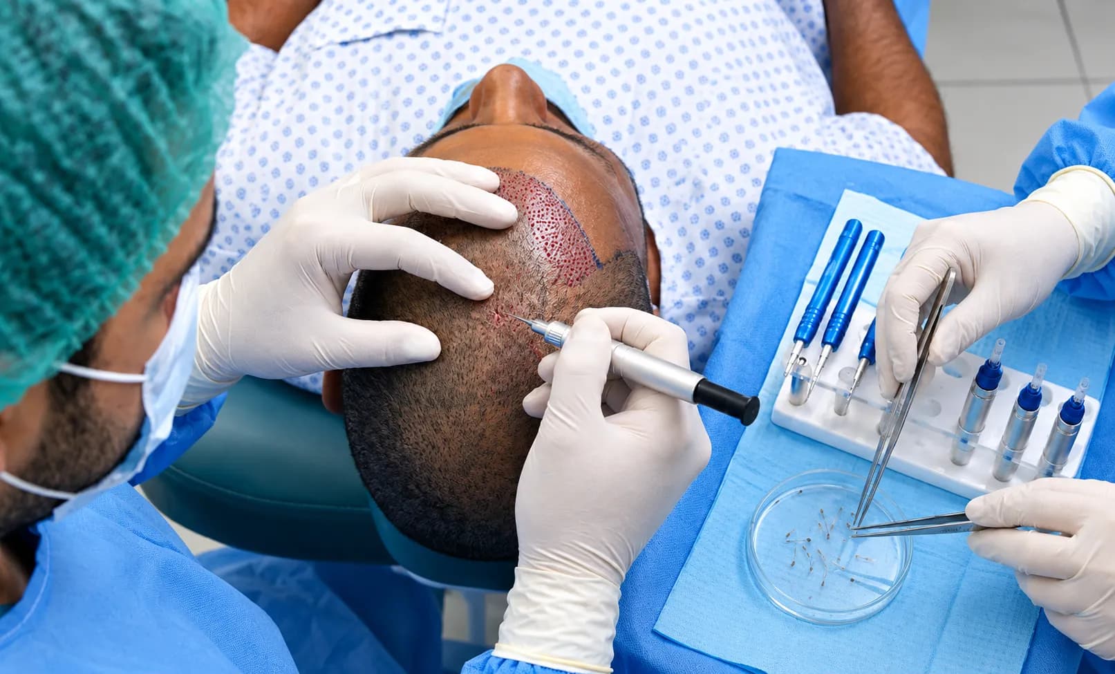DHI hair transplant technology